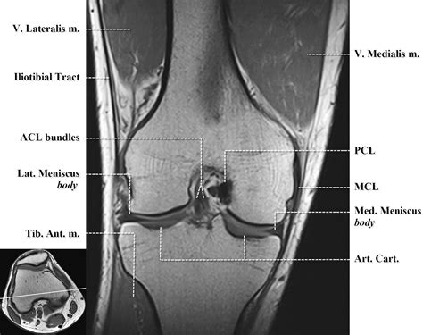 Supplemental Materials For Normal Mr Imaging Anatomy Of The Knee
