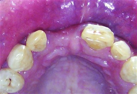 Facial View Of Alveolar Ridge Defi Ciency Figure 2 Occlusal View Of