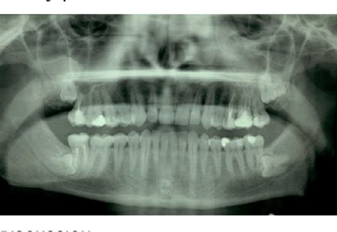 Figure 2 From Management Of A Non Syndromic Case Of Maxillary And