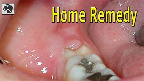 Tooth Infection Treatment At Home Review Home Co