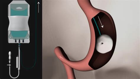 Experimental Weight Loss Device You Swallow Like A Pill Cbs News