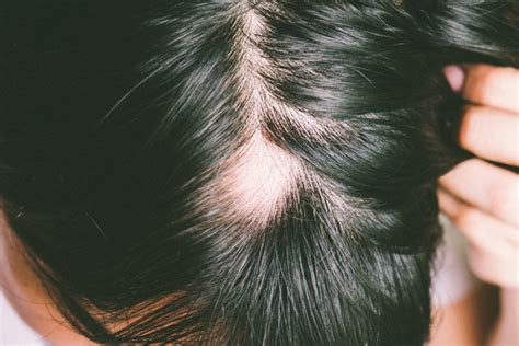 Sur quelles coiffures et coupes miser quand on a les cheveux clairsemés? Quelle Coupe Quand On Perd Ses Cheveux Femme : Quelle ...