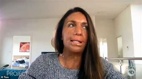 Turia Pitt Explains The Process Of Recovering From Her Devastating Burns Daily Mail Online