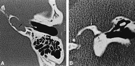 Ct And Mr Findings Of Michel Anomaly Inner Ear Aplasia American