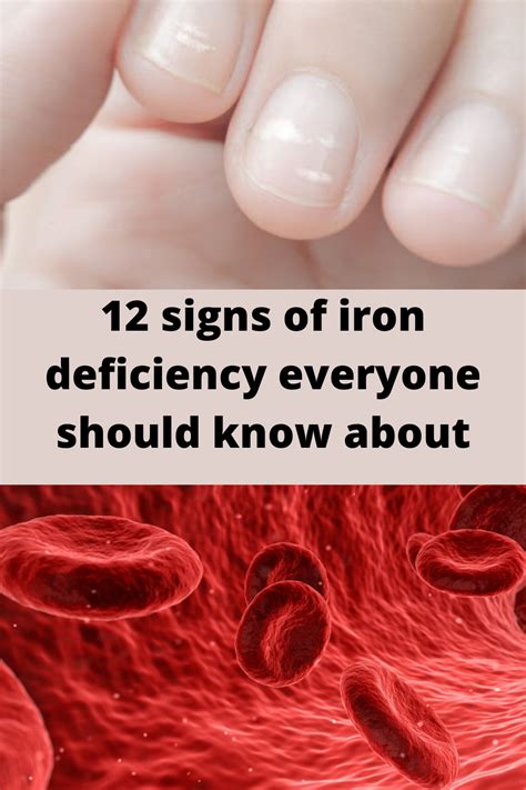 12 Symptoms Of Iron Deficiency Everyone Must Know About Signs Of Iron Deficiency Iron