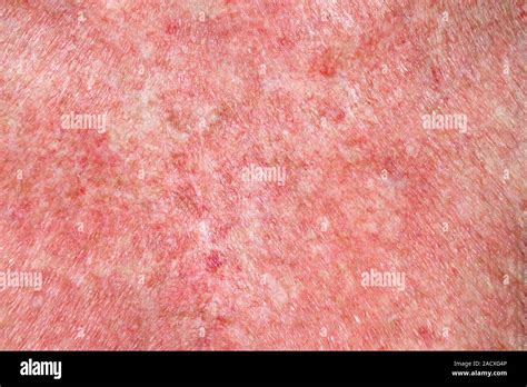 Close Up De Dermatitis Exfoliativa Ed Sobre La Piel De Una Paciente