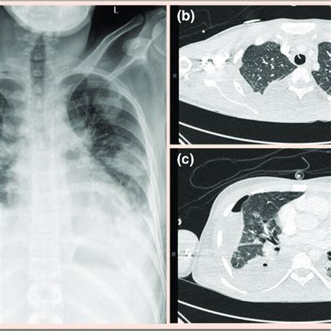 Chest X Ray A And Axial Ct Slices B And C Demonstrating Multiple