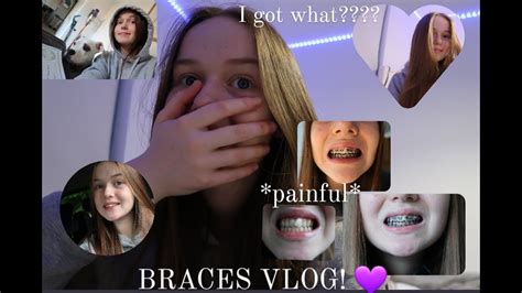 I Got Braces Getting Braces Vlog Updates Youtube