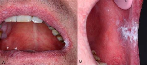 Leukoplakia On The Mucosa Of The Labial Commissure A Extraoral View