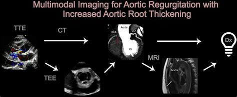 Takayasu Arteritis Causing Aortitis And Aortic Regurgitation A Totally