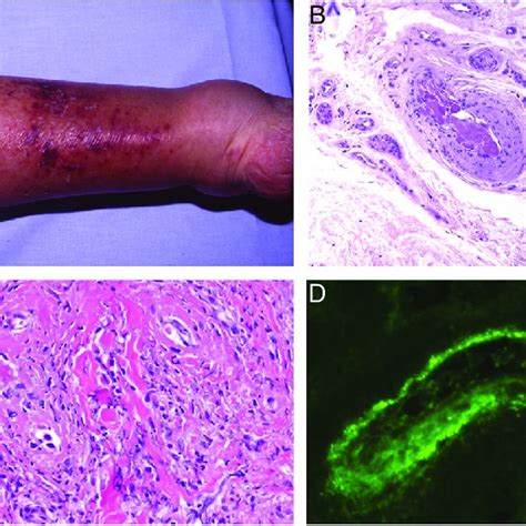 Ecthyma Gangrenosum In Neonatal Chronic Granulomatous Disease Multiple