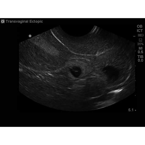 Blue Phantom Ectopic Pregnancy Transvaginal Ultrasound Training Model