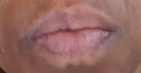 What Causes A White Line Around The Lips