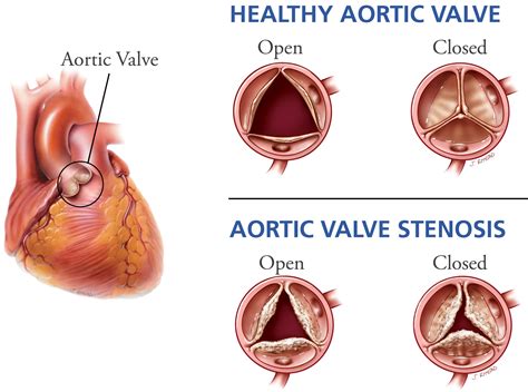 Aortic Valve Heart Valve Disease Aorta Png Clipart Anatomy Aorta Sexiz Pix