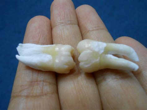 Bila gigi bungsu kamu tumbuh lurus sempurna dan ngga mengganggu sebelahnya maka gigi ngga perlu dicabut. Pengalaman Cabut Gigi Bongsu (Pt 1)