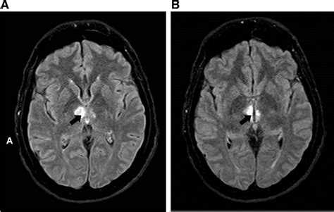 Role Of Neurorehabilitation In The Recovery Of Bilateral Thalamic Stroke Related To The Artery