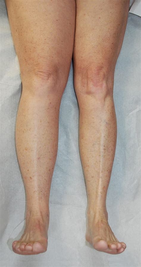 Lymphedema Surgery