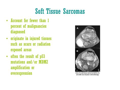 Ppt Mdm2 And Soft Tissue Sarcomas Powerpoint Presentation Free