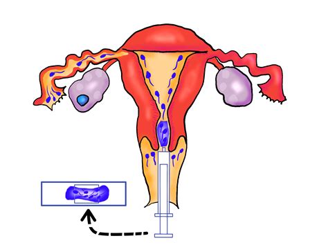 Mullerian agenesis, abbreviated as ma, is a disorder marked by congenital malformation. ミュラー管無発生 - Müllerian agenesis - JapaneseClass.jp