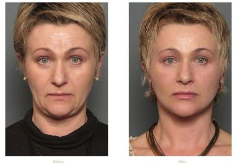 Facelift Raleigh NC Face Lift Surgery Best Face Products Cosmetic Surgery