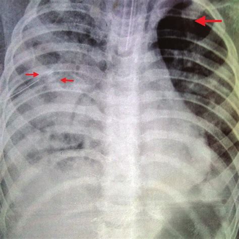 Chest X Ray Of The Patient After Intercostal Chest Tube Drainage Red