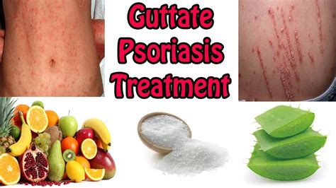 Guttate Psoriasis Treatment Best Cure For Guttate Psoriasis With