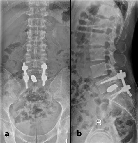 Cureus Revision Spinal Surgery For Posterior Migration Of Tantalum Cage Tips And Tricks