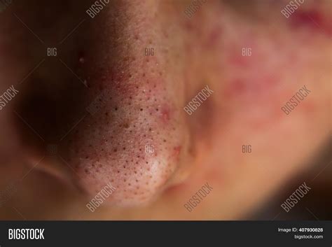 Closed Pimple Image And Photo Free Trial Bigstock