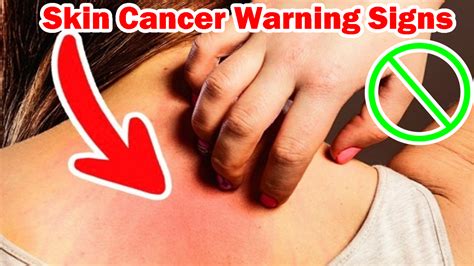 Know The Warning Signs Of Skin Cancer Bitly3svxgze Nnone Of The Most Common
