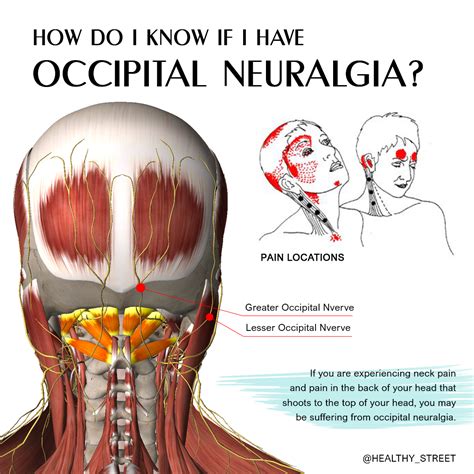 Occipital Nerve And Vision