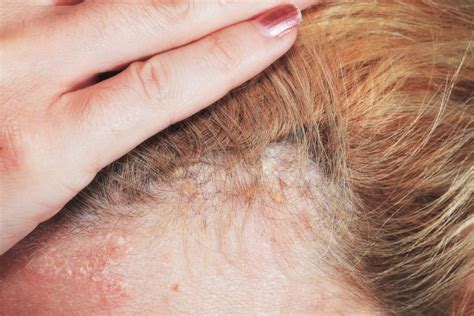 Scalp Psoriasis Shampoos Home Remedies And Causes