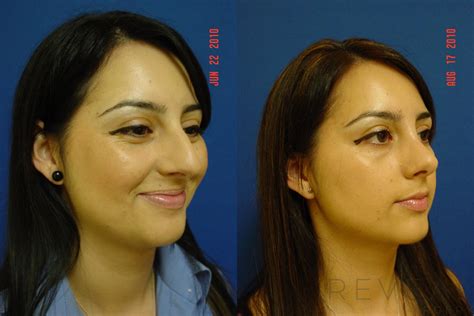 Rhinoplasty Before And After Pictures Case 44 San Jose Ca Reveal