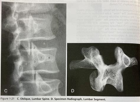 Radiology Oblique Lumbar Spine Diagram Quizlet