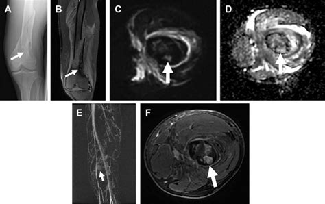 Mr Imaging Of Pediatric Musculoskeletal Tumors Radiology Key