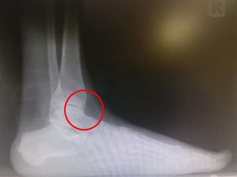 Chipped Ankle Bone The Home Diagnosis And Treatment Guide