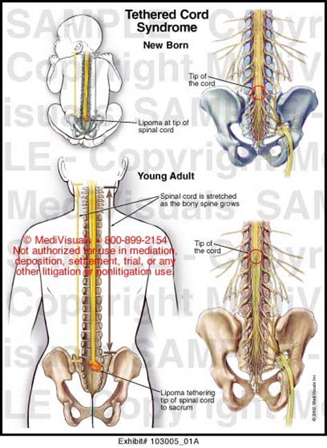 Spinal What Is A Tethered Spinal Cord