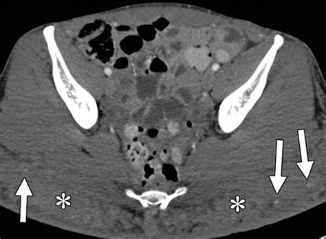 Diagnostic Approach To Benign And Malignant Calcifications In The