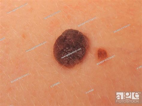 Intradermal Nevus Stock Photo Picture And Rights Managed Image Pic