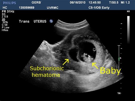 Twinlala Subchorionic Hematoma Placenta Previa And Bedrestoh My