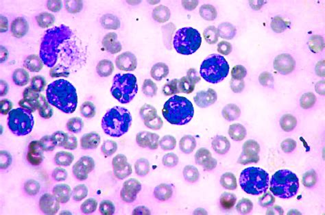 Peripheral Smear Showing Predominantly Mature Neutrophils And Band Forms Download Scientific