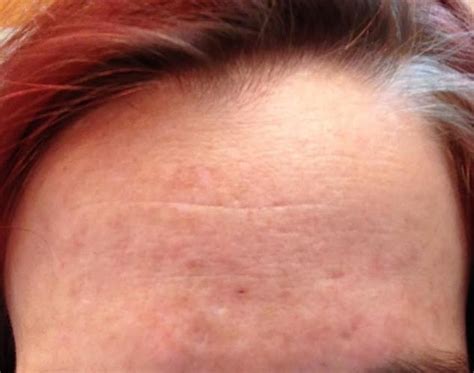 Hole In Middle Of Forehead Scar Treatments Community