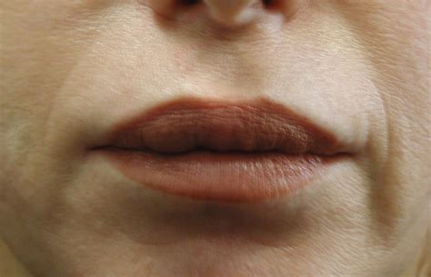 Chicago Collagen Lip Injections View The Result Of Chicago Collagen