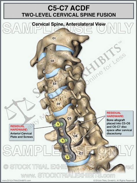 Cervical Spine Fusion C5 C7 Acdf Stock Trial Exhibits