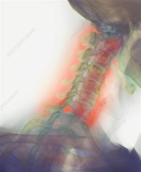 Osteoarthritis Of Neck X Ray Stock Image M1100536 Science Photo