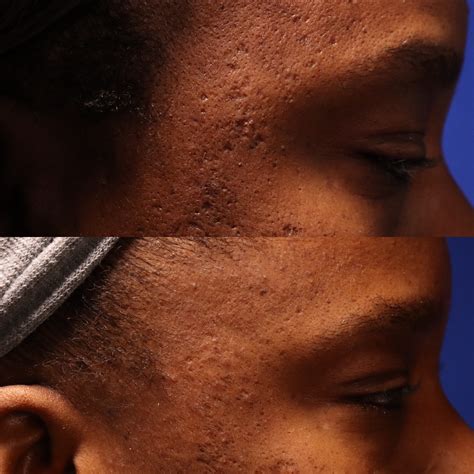 Acne Scar Treatment For Patients Of African Descent