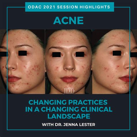 Acne Changing Practices In A Changing Clinical Landscape Next Steps