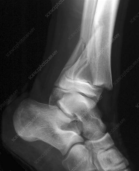 Fractured Ankle X Ray Stock Image C0269999 Science Photo Library