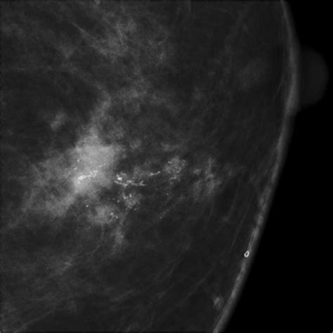 Typical Casting Type Calcifications Seen On Mammography Download Scientific Diagram