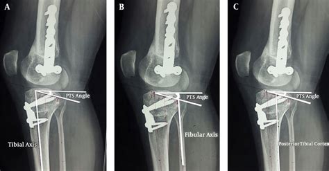 Radiographic Assessment Of The Posterior Tibial Slope Pts Using Three