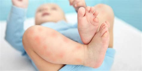 Kenali Dari Awal Faktor Penyebab Alergi Pada Bayi Hot Sex Picture